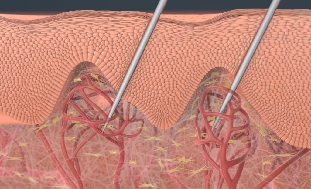 How works Microneedling