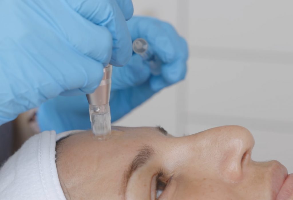 Microneedling Dermapen