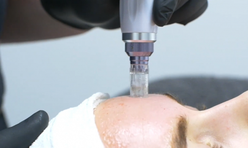 What Is Microneedling and How Can It Benefit Your Skin?