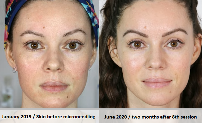 Results before microneedling and after