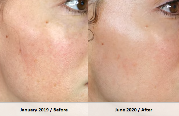 Results before microneedling and after